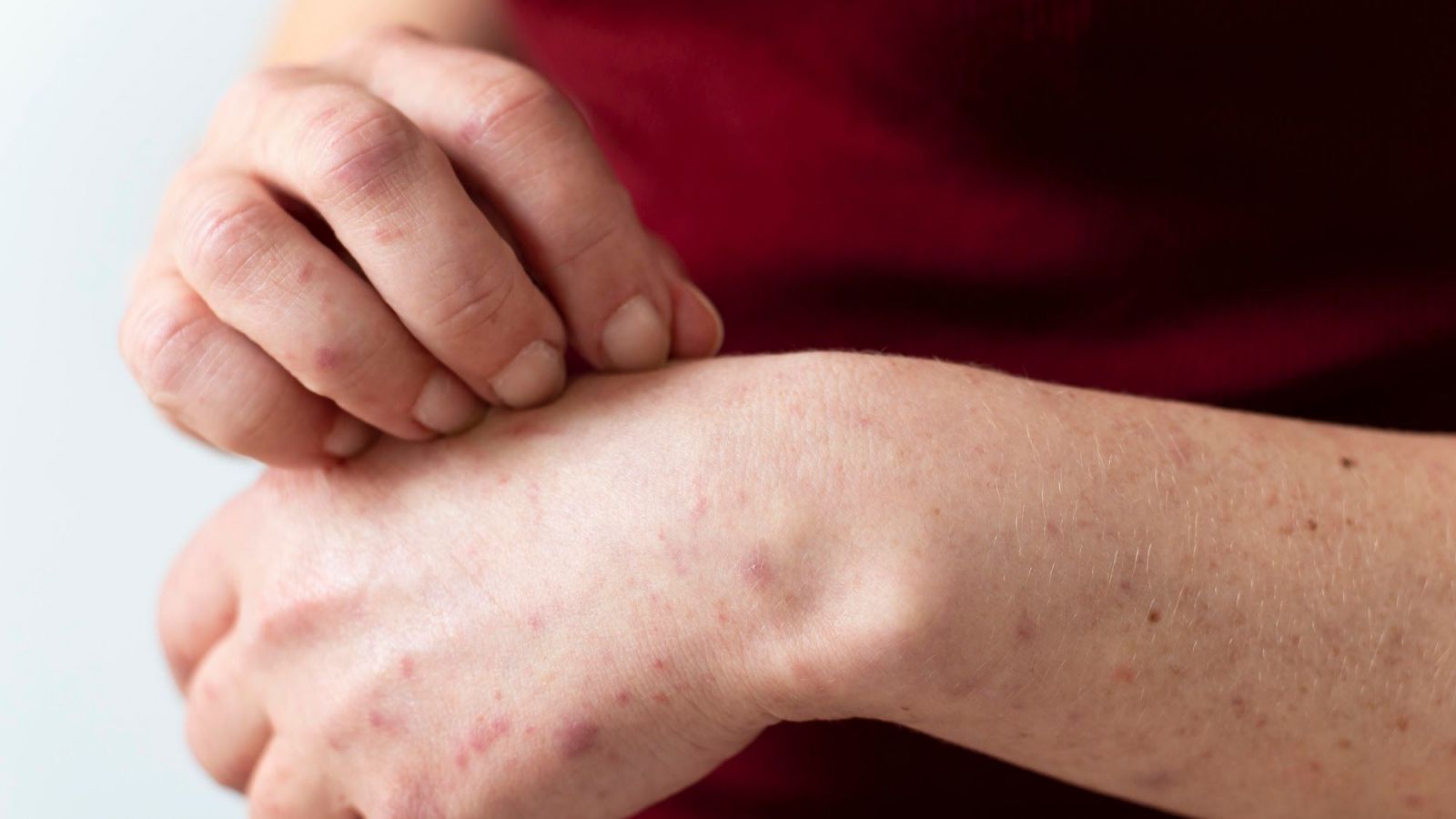 Alerta sanitaria por sarampión: ¿Quiénes deben vacunarse?
