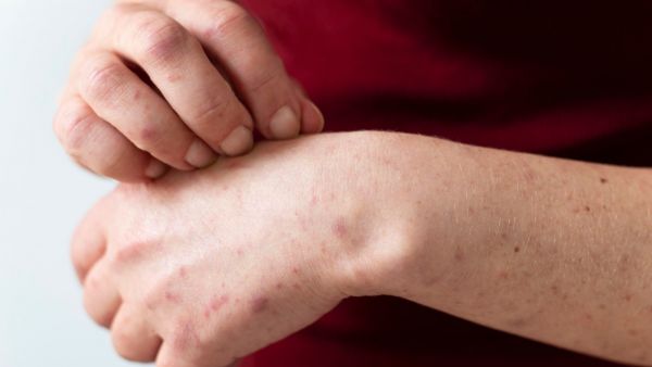 Alerta sanitaria por sarampión: ¿Quiénes deben vacunarse?
