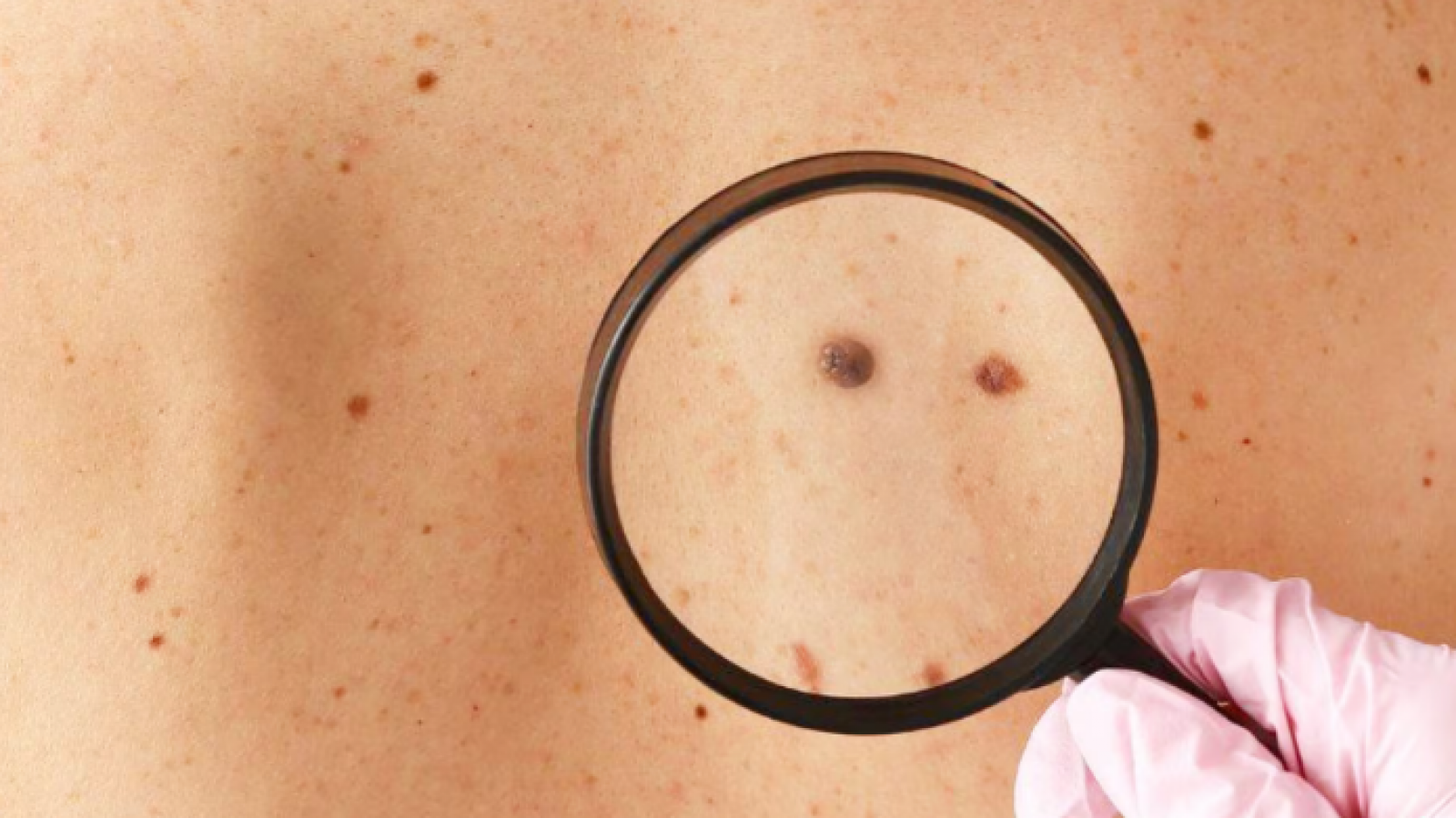 <p>Día Mundial del Cáncer de Piel: Revisa las recomendaciones para prevenirlo </p>
