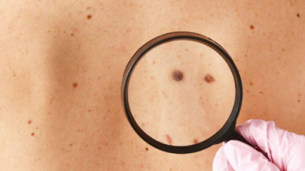 <p>Día Mundial del Cáncer de Piel: Revisa las recomendaciones para prevenirlo </p>Día Mundial del Cáncer de Piel: Revisa las recomendaciones para prevenirlo
