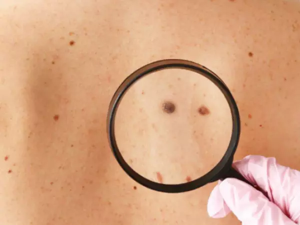 Día Mundial del Cáncer de Piel: Revisa las recomendaciones para prevenirlo