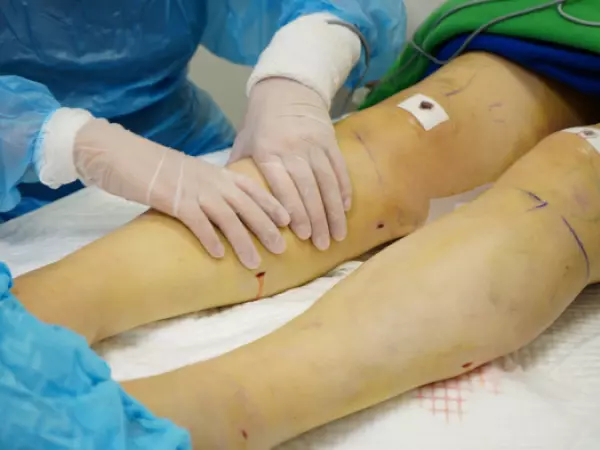 Junio, Mes del Lipedema: patología es reconocida oficialmente como enfermedad crónica y progresiva