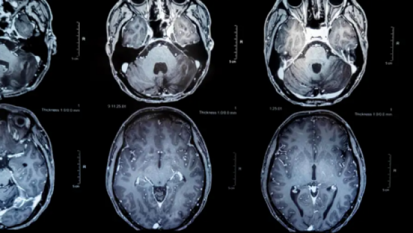 Tumores cerebrales: nueva vacuna ofrece esperanza de vida
