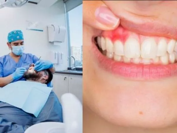 ¿Se pueden perder dientes sanos por culpa de la periodontitis?