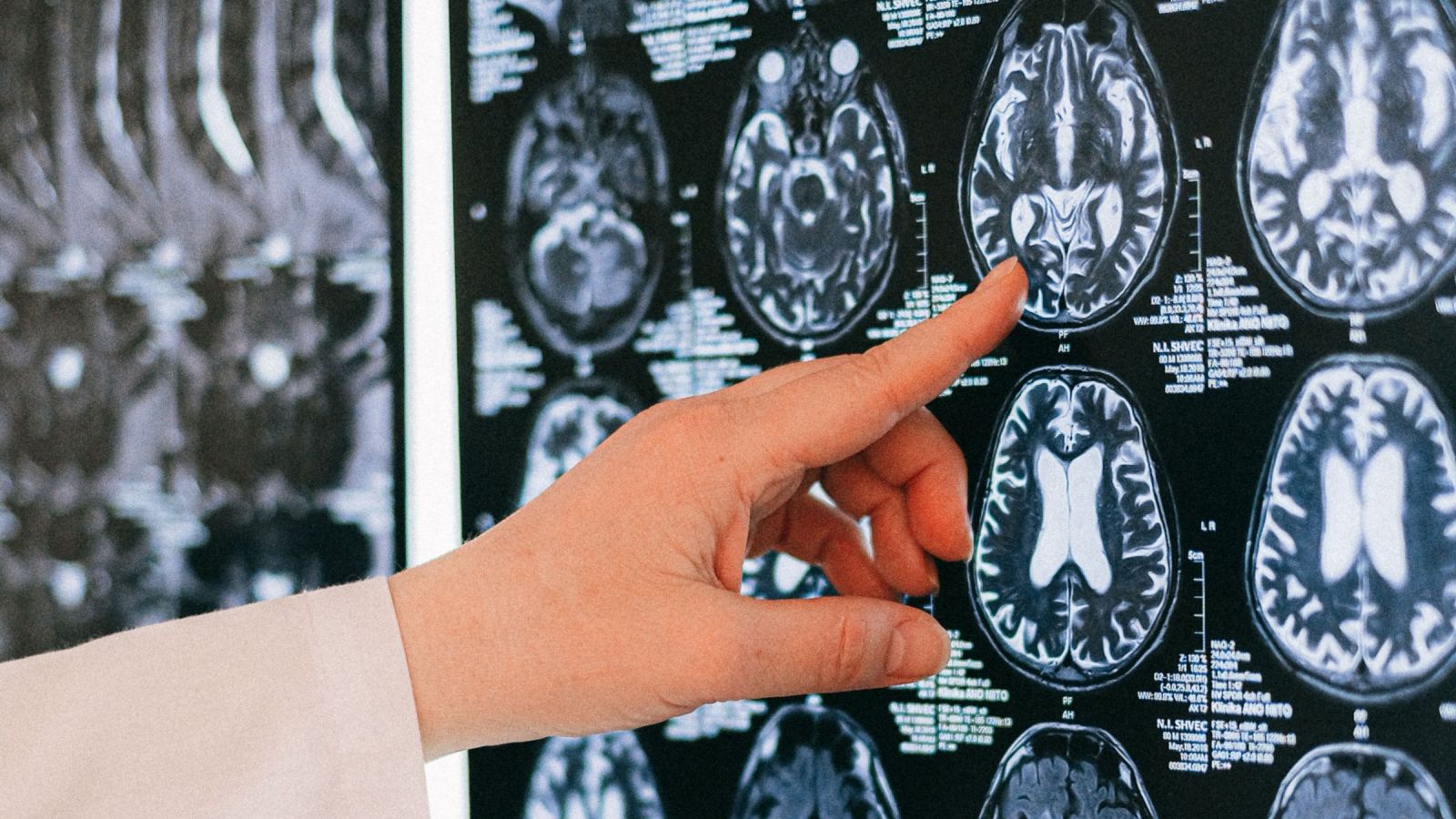 ¿Cuáles son los síntomas de la esclerosis múltiple? Neuróloga explica las señales de alerta de esta enfermedad autoinmune
