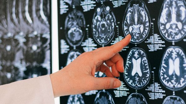 ¿Cuáles son los síntomas de la esclerosis múltiple? Neuróloga explica las señales de alerta de esta enfermedad autoinmune
