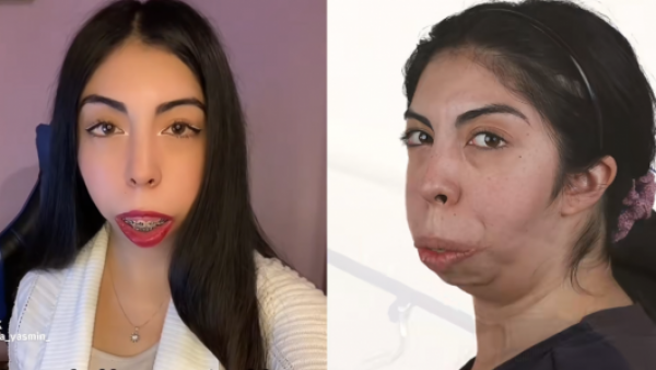<p>Joven chilena con síndrome de Treacher Collins muestra su antes y después tras cirugía</p>Joven chilena con síndrome de Treacher Collins muestra su antes y después tras cirugía
