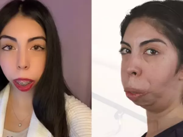 Joven chilena con síndrome de Treacher Collins muestra su antes y después tras cirugía