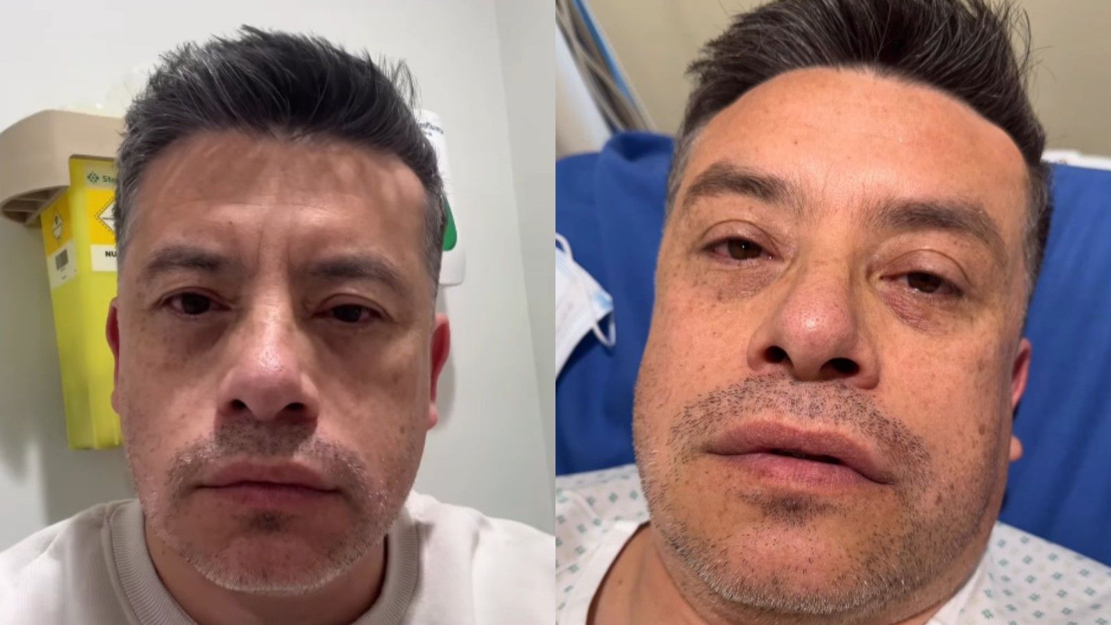 "Se me cayó la mitad de la cara": El gran susto médico de exchico "Rojo" que preocupó a sus seguidores
