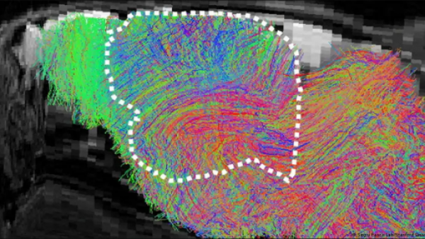 <p>Trasplantan tejido cerebral humano en ratones de laboratorio</p>Trasplantan tejido cerebral humano en ratones de laboratorio
