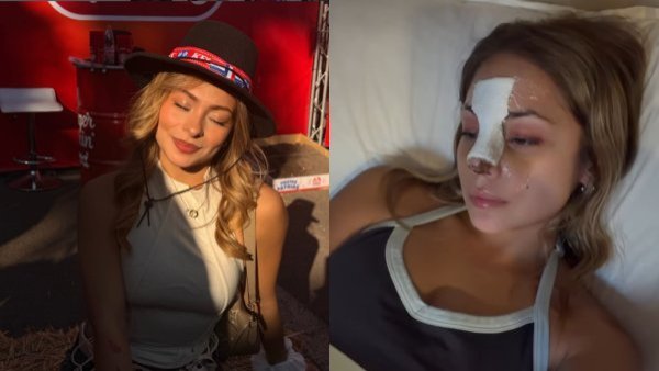 "100% por salud": Exchica reality sorprende con su antes y después tras revelar inédita cirugía facial