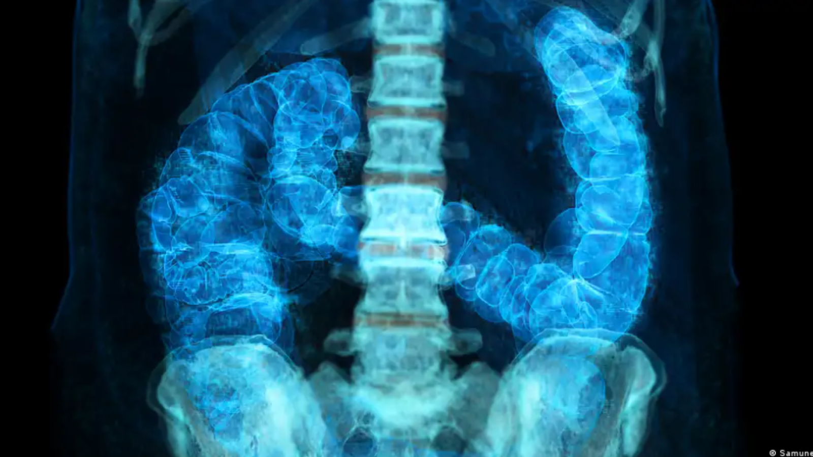 Cáncer precoz: ¿por qué aumentan los casos en menores de 50 años?

