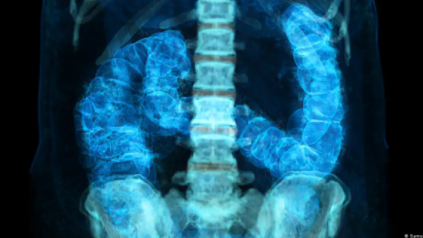 Cáncer precoz: ¿por qué aumentan los casos en menores de 50 años?